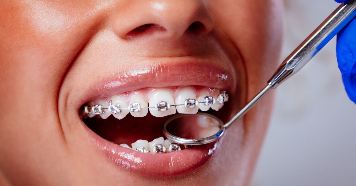Colocación de Brackets